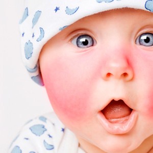Причины появления диатеза у новорожденного на лице?