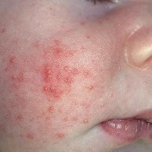 Аллергия у новорожденных на лице: причины и меры профилактики