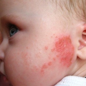 Особенности лечения дерматита у детей