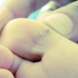 Бородавки на ногах: причины появления и методы лечения