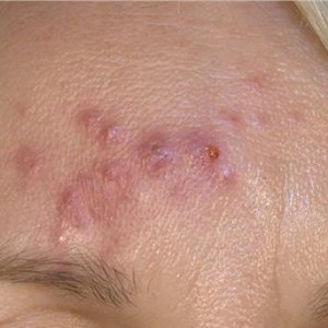 Что такое демодекс на лице? Основные симптомы