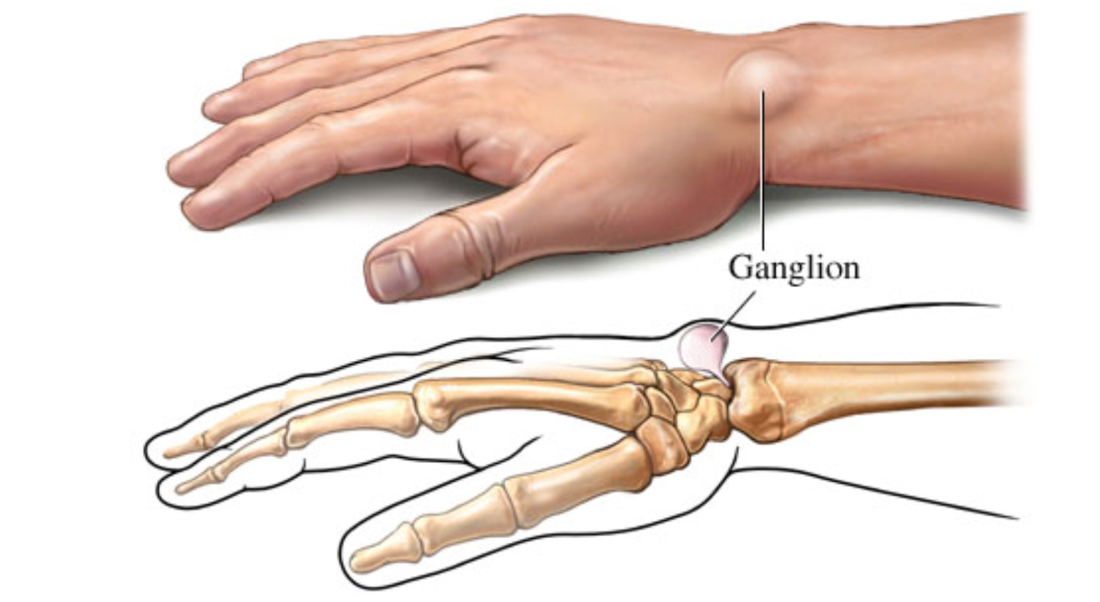Болит основание сустава большого пальца. Гигрома сухожильный ганглий. Гигрома лучезапястного сустава. Ганглион лучезапястного сустава. Стенозирующий лигаментит.