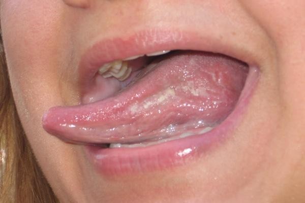 Молочница во рту: симптомы и лечение