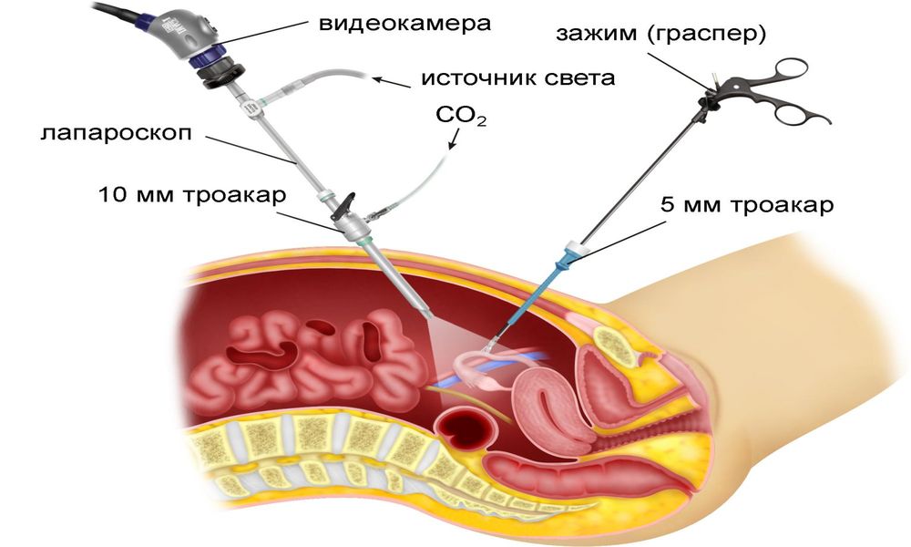 Беременность после лапароскопии маточных труб или яичников