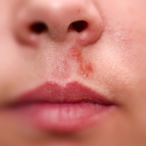 Герпес на носу: причины возникновения, лечение