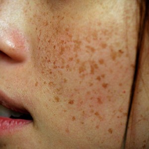 Коричневые пятна на лице: причины и как избавиться от них