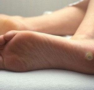 Бородавка у ребенка на ногах: причины появления, лечение