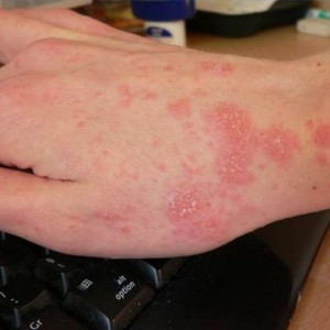 Заболевания кожи рук виды и лечение