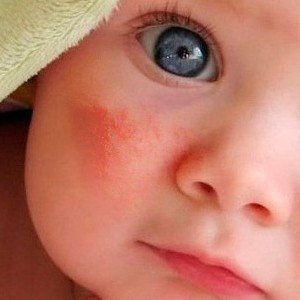 Почему у ребенка шелушится кожа?