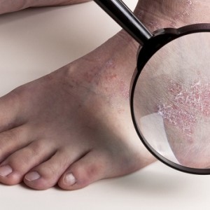 По каким причинам слезает кожа на ногах?