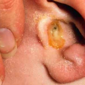 Зуд в ухе: симптоматика, причины и лечение