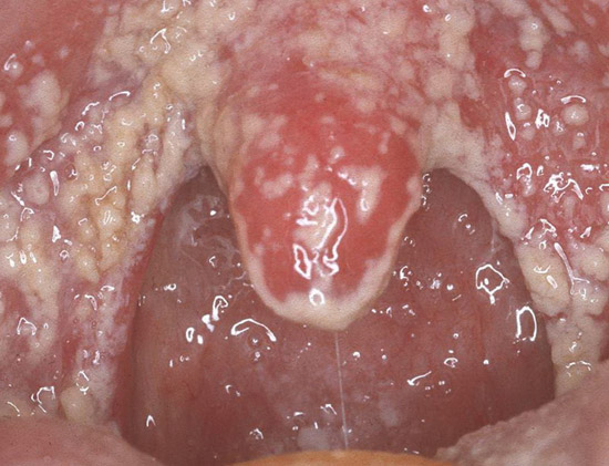 Грибковые заболевания горла: симптоматика и лечение
