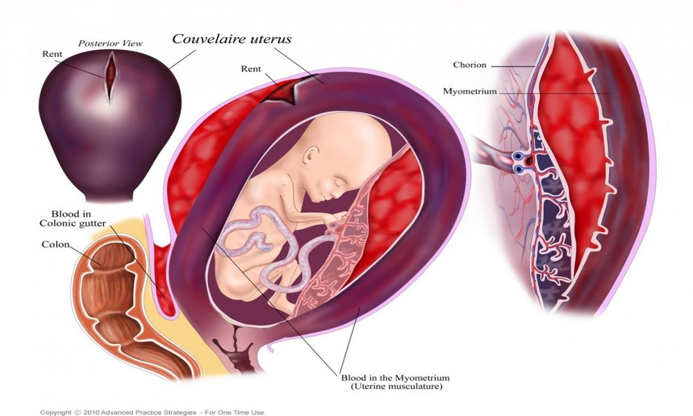 Осложнения при родах-разрывы, кровотечение, гипоксия