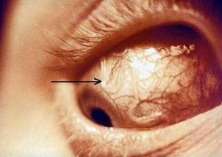 Дирофилярия в глазу