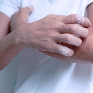 Симптомы холодового дерматита и его отличительные признаки
