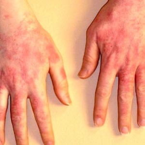 Симптомы и лечение аллергического дерматита у взрослых