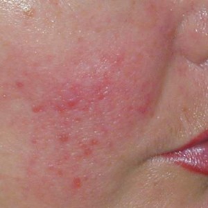 Мелкая сыпь на лице у взрослого: причины, фото