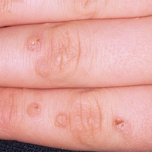 Возникновение бородавок на пальцах рук, лечение