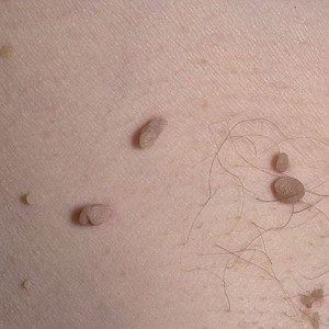 Папилломавирусная инфекция у женщин, фото