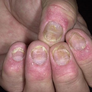 Как лечить псориаз ногтей на руках