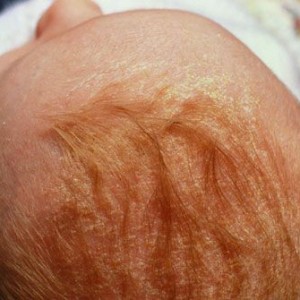Почему у ребенка шелушится кожа?