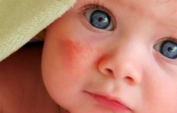 Причины появления диатеза у новорожденного на лице?