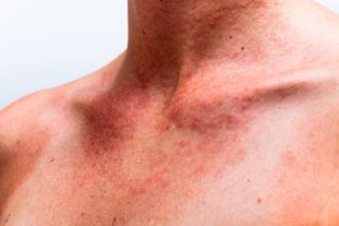 Наличие аллергических реакций (сыпь на коже, заложенность носа) говорит об интоксикации тела продуктами жизнедеятельности паразитов