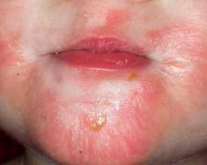 Как побороть аллергический дерматит у взрослых?