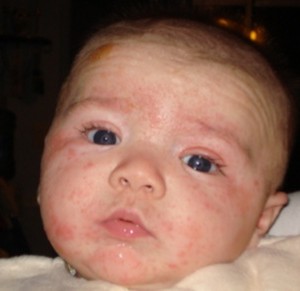 Детский дерматит: разновидности болезни и как её лечить?