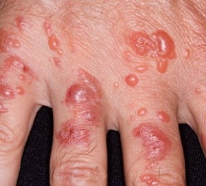 Симптомы и лечение аллергического дерматита у взрослых
