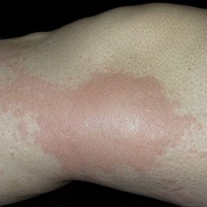 Симптомы васкулита кожных покровов, фото