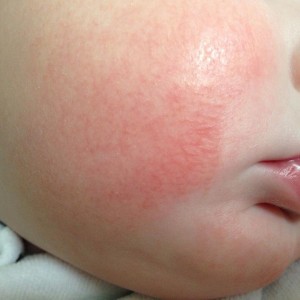 Особенности лечения дерматита у детей