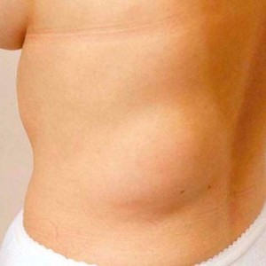 Жировики на теле: причины появления липом и атером