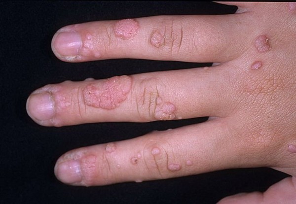 Возникновение бородавок на пальцах рук, лечение