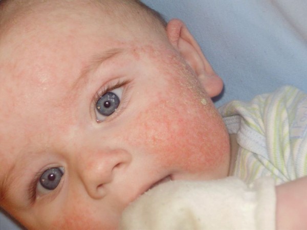 Аллергия у новорожденных на лице: причины и меры профилактики