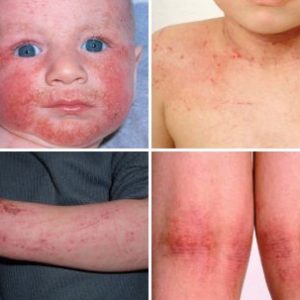 Детские кожные заболевания: симптомы и причины появления
