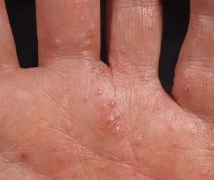 Болезнь кистей рук: как лечить дисгидротическую экзему
