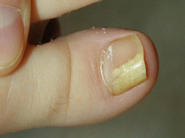 Лечение грибка ногтя запущенной формы при помощи перекиси
