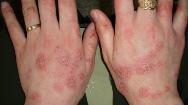 Заболевания кожи рук виды и лечение