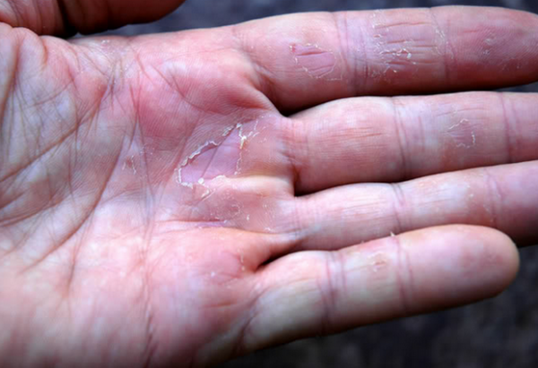 Что делать, если на пальцах рук ребенка слезает кожа