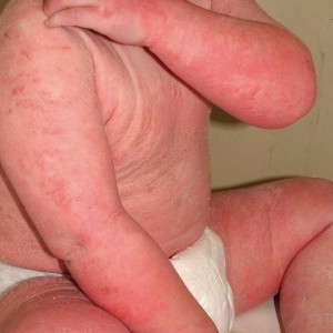 Детский дерматит: разновидности болезни и как её лечить?