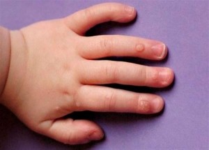 Бородавки у ребенка: причины появления и лечение
