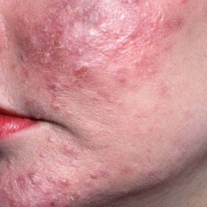 Что такое демодекс на лице? Основные симптомы