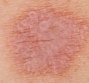 Появление лишая на коже: причины, лечение и профилактика