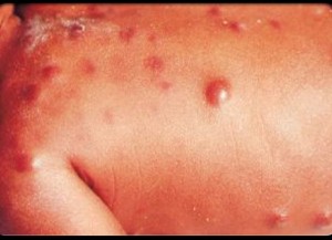 Появление лишая на коже: причины, лечение и профилактика