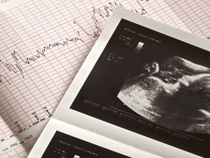 Расшифровка кардиотокографии КТГ плода при беременности