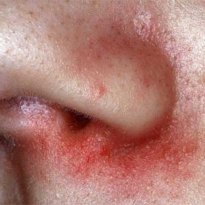 Герпес на носу: причины возникновения, лечение