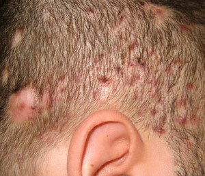 Экзема и кожные проблемы головы: особенности заболевания