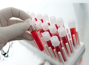 В анализе крови при паразитарной инвазии должны присутствовать антитела IgM или IgG