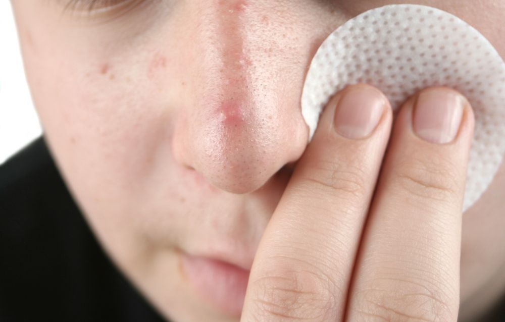 Угревая сыпь на лице: что делать